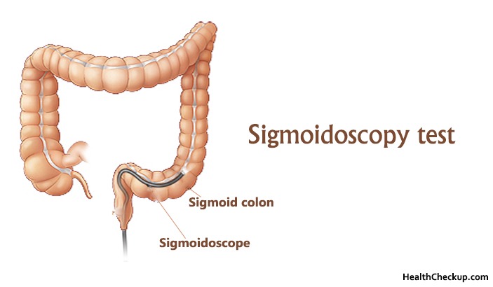 Sigmoidoscopy test