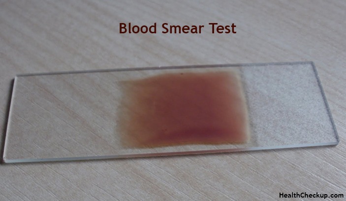 Peripheral Blood Smear Test:Procedure,results