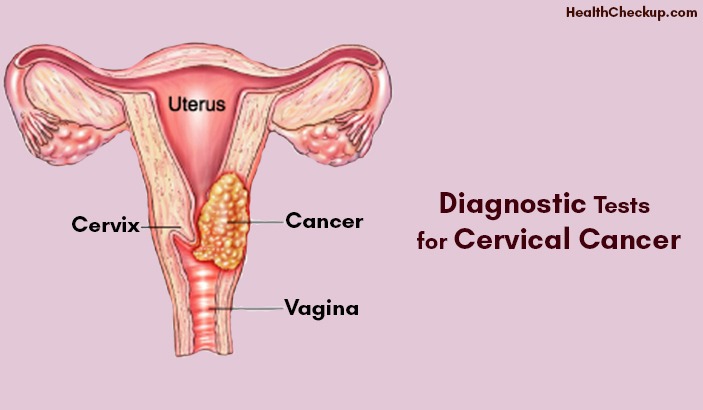 Diagnostic Tests for Cervical Cancer