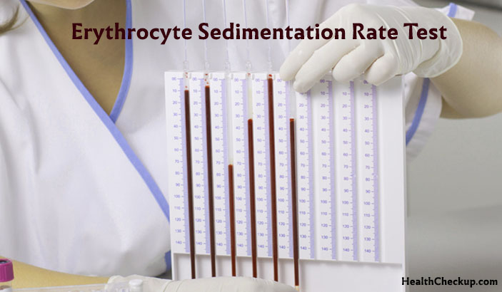 Erythrocyte Sedimentation Rate (ESR) Test : Procedure and Normal Results