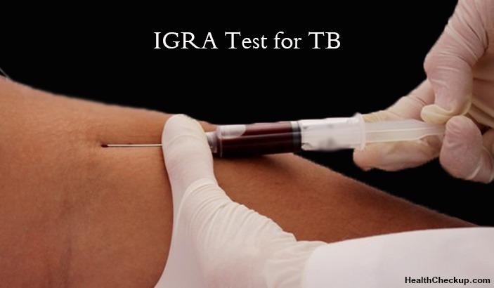 IGRA Test for TB