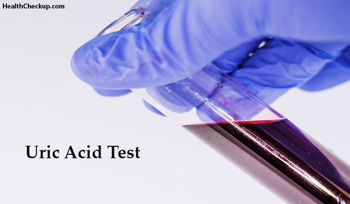 Uric Acid Test Causes, Symptoms and Procedure-normal values of uric acid