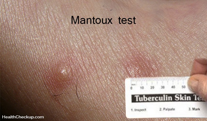 Mantoux Test-Tuberculosis skin test
