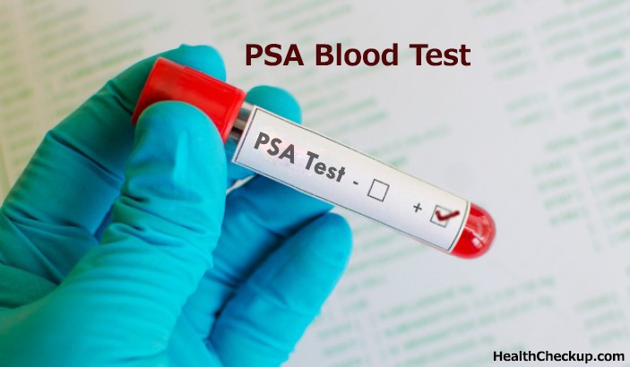 PSA Blood Test Preparation-results of psa test