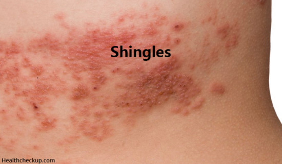 Herpes Zoster Or Shingles Symptoms And Treatment Healthcheckup