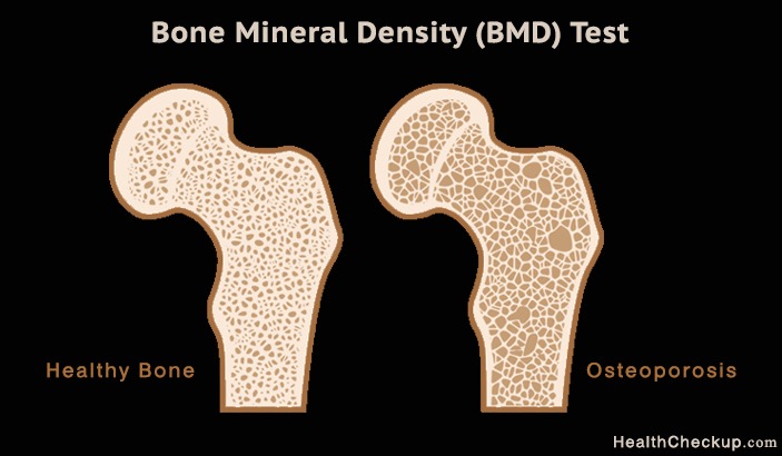 Bone Mineral Density Test (BMD) for Osteoporosis-Signs, Symptoms