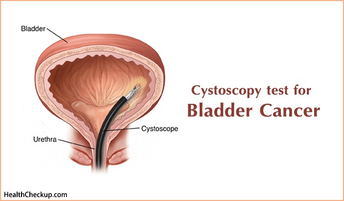 Cystoscopy Test for Bladder Cancer -What is Cystoscopy?