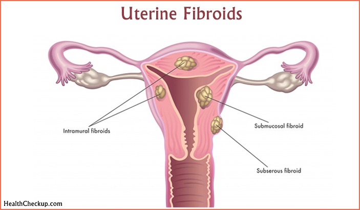 Uterine Fibroids Tests | Symptoms,Causes of Uterine Fibroids
