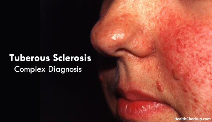 Tuberous Sclerosis Complex Diagnosis and Treatment