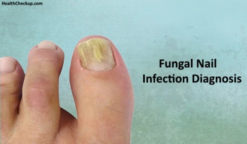 Fungal Nail Infection Test | Treatment ,Results of Fungal Nail Infection