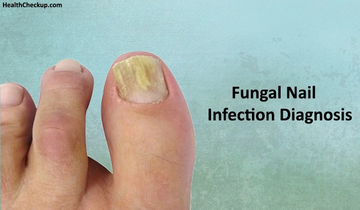 Fungal Nail Infection test and treatment
