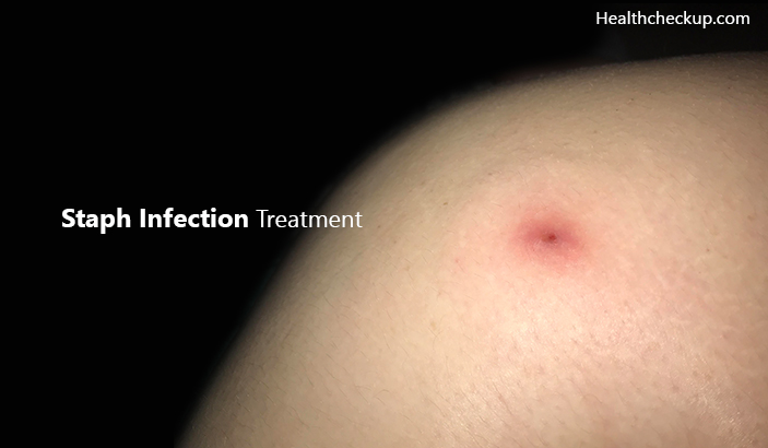 staph infectionTreatment