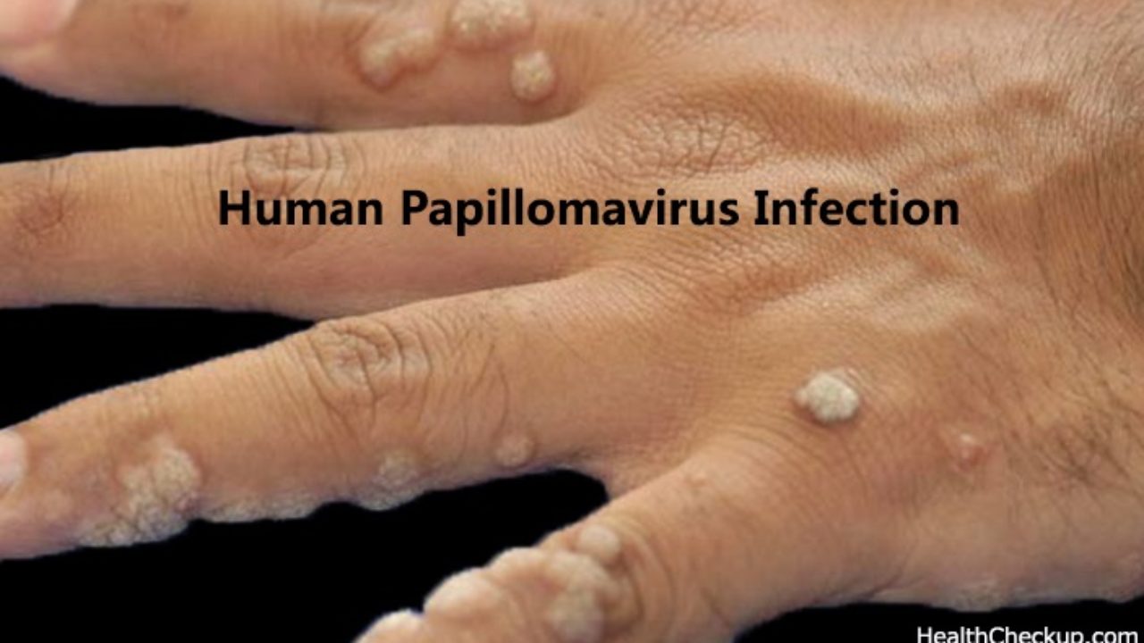 human papillomavirus infection treatment)