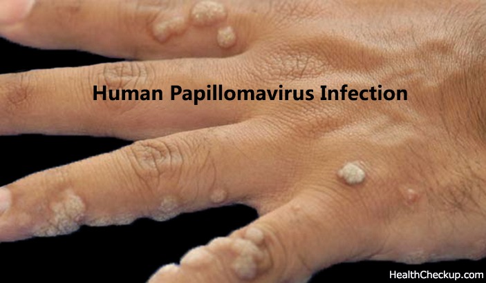 Human Papillomavirus Infection Symptoms and Treatment