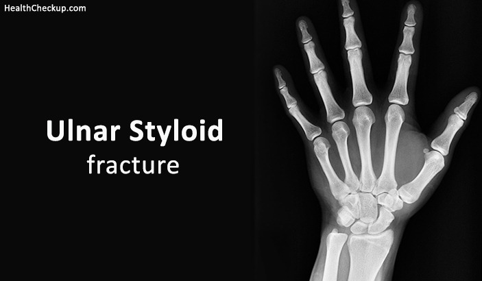 Ulnar Styloid fracture