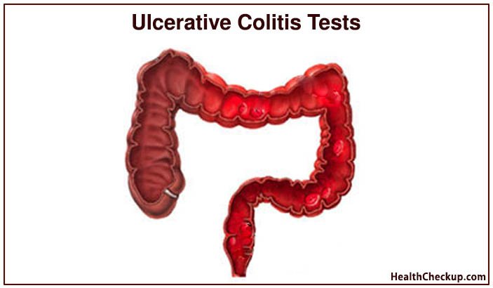 Ulcerative Colitis Tests: Causes, Symptoms and Diagnosis