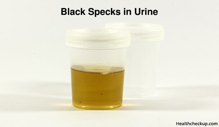 Black Specks in Urine/health checkup