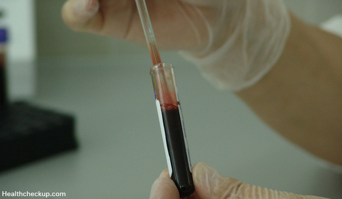 Blood Urea Nitrogen - BUN Test