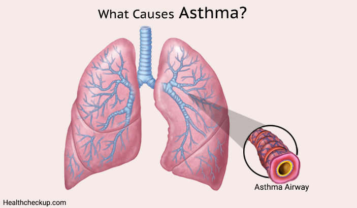 what are Asthma Causes?-types of asthama