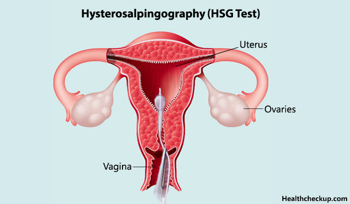 HSG Test(Hysterosalpingography)-procedure and results