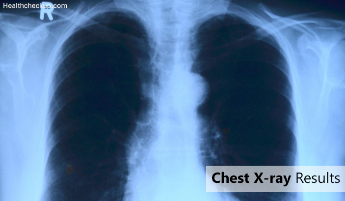 Chest X-ray Results