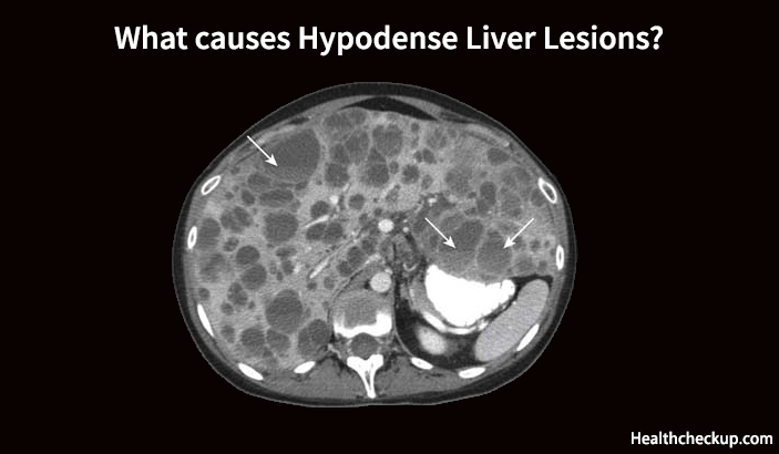 What causes Hypodense Liver Lesions?