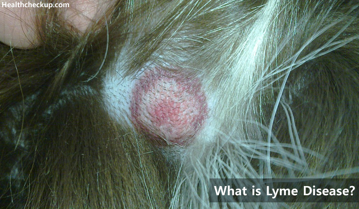 What is Lyme Disease test symptoms and treatment