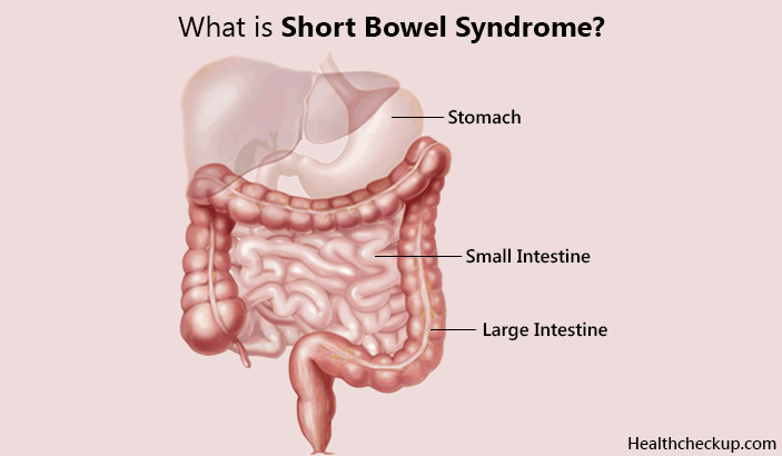 What is short bowel syndrome-symptoms and causes of sbs