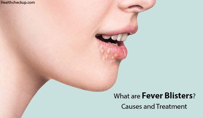 fever blisters causes and treatment