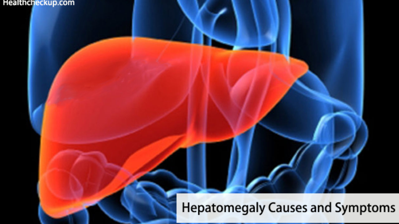 Mild Massive Tender Hepatomegaly Causes And Symptoms Mild Massive Tender Hepatomegaly Causes And Symptoms