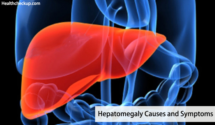 Hepatomegaly Causes and Symptoms-liver is enlarged and is swollen