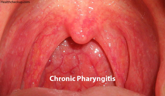 Chronic Pharyngitis Types Causes Symptoms Diagnosis Treatment