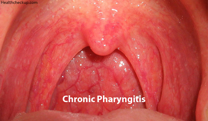 Chronic Pharyngitis