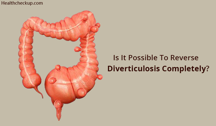 Is It Possible To Reverse Diverticulosis Completely?