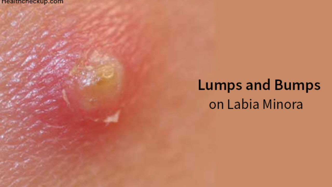 Labia outer lump on What are