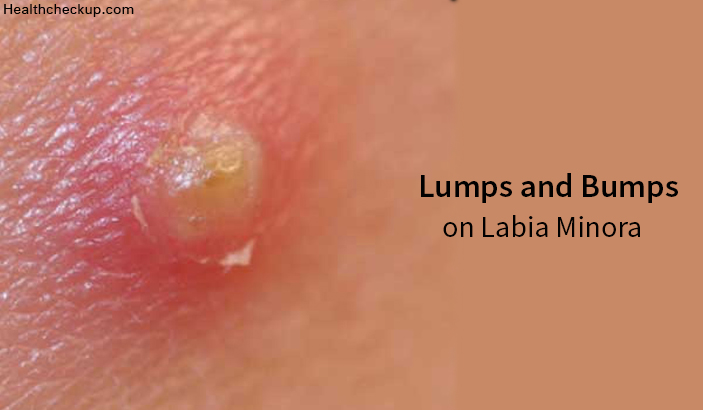 Lumps and Bumps on Labia Minora