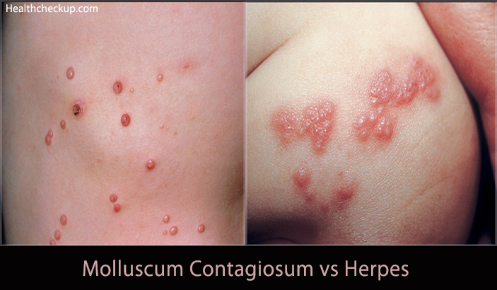 Molluscum Contagiosum vs Herpes