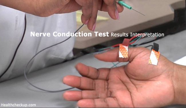 Nerve Conduction Test Results Interpretation Health Checkup