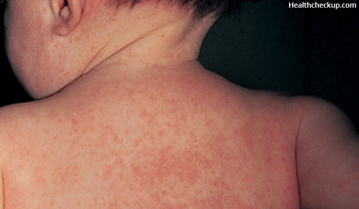 Viral Rashes in Children: Causes, Symptoms and Prevention
