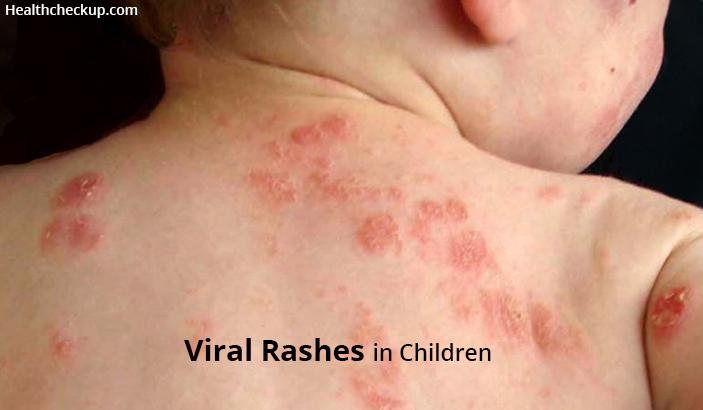 Viral Rashes in Children