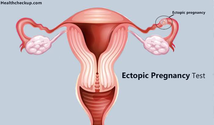 Ectopic pregnancy Test