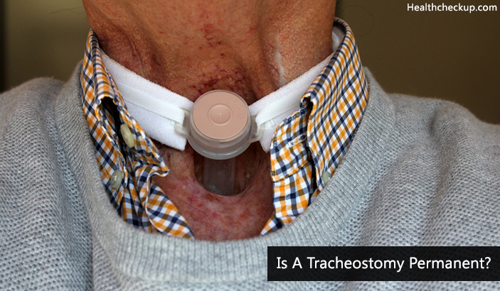 Is A Tracheostomy Permanent?