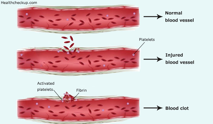 Blood Clots Picture