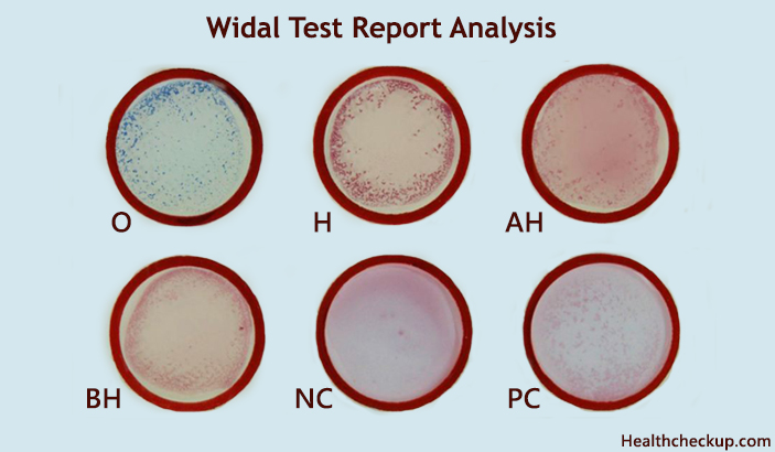 widal test report analysis