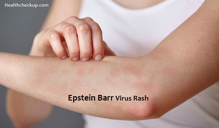 Epstein Barr Virus Rash