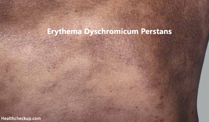 Erythema Dyschromicum Perstans
