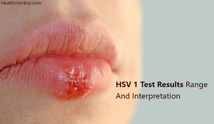 HSV 1 Test Results Range and interpretation