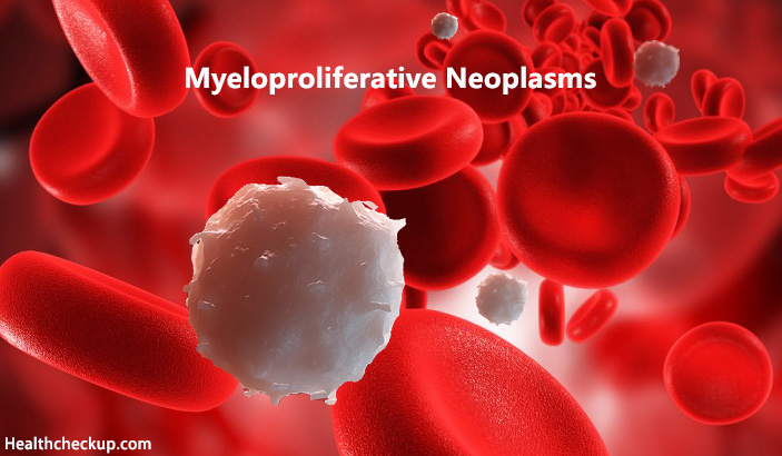 Myeloproliferative Neoplasms