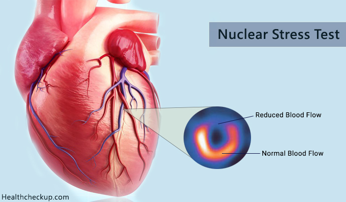 Nuclear Stress Test