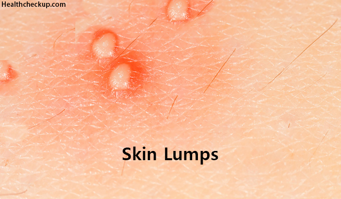 Skin Lumps